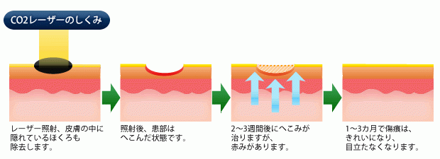 シミ 治療