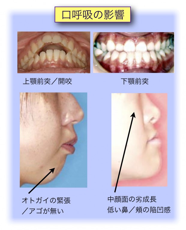 口呼吸 歯並び 顔